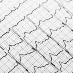 Webb-TV: Förmaksflimmer